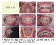 최광효 원장의 덧니와 과개교합이 심한 청소년 환자의 안모를 고려한 교정치료 - 덴탈아리랑 최광효 원장의 덧니와 과개교합이 심한 청소년... 
