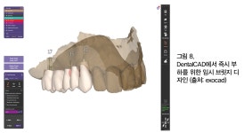 [임상증례] 치과와 기공소간 안정적 인터페이스에 기반한 exocad 솔루션 임상 - 덴탈아리랑 [임상증례] 치과와 기공소간 안정적... 