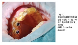 [임상증례] 치과와 기공소간 안정적 인터페이스에 기반한 exocad 솔루션 임상 - 덴탈아리랑 [임상증례] 치과와 기공소간 안정적... 
