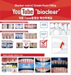 바이오클리어, 치아 삭제 없이 완성하는 심미 수복 솔루션 소개 - 덴탈아리랑 바이오클리어, 치아 삭제 없이 완성하는 심미 수복 솔루션 소개