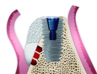 골유도재생술 한계 극복... 아침해의료기, 하버드대와 공동 연구 - 덴탈아리랑 골유도재생술 한계 극복... 아침해의료기, 하버드대와 공동 연구