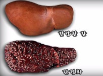 횐님덜을,,,위해,,,간경화사진,,,올리고갑니다,,, - DogDrip.Net 개드립