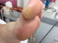 엄지발가락 굳은살 너무 심한데 어디로 가면 돼? 사진 예시 보여줌 - DogDrip.Net 개드립