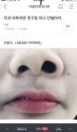 치과 마취하면 콧구멍 하나 안벌어져 - DogDrip.Net 개드립