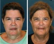 28년동안 왼쪽얼굴만 햇빛받은 트럭기사.jpg - DogDrip.Net 개드립