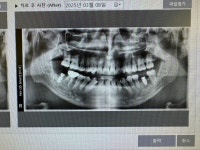 한큐에 이 6개 정리하고 임플란트 박았다 - DogDrip.Net 개드립