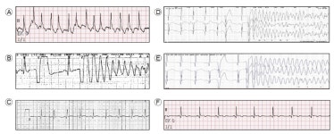 Cardiac Arrest Related to Torsades de Pointes in a Patient Recovering from Diabetic Ketoacidosis