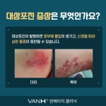 [백년소녀의 요기아파?] (1)대상포진 치료부터 후유증 관리까지 - 헬스컨슈머 [백년소녀의 요기아파?] (1)대상포진 치료부터 후유증 관리까지