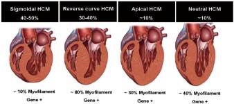 Inherited Cardiomyopathies