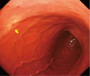 pylori陽性胃MALTリンパ腫の除菌治療後に異時性のt（11；18）... pylori陽性胃MALTリンパ腫の除菌治療後に異時性のt（11；18）... 