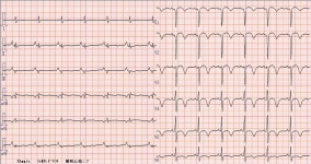 A case of effort angina pectoris with coronary spastic angina for which 24 hour holter electrocardiography was useful