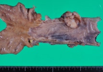 A Case of Neuroendocrine Carcinoma with Sarcomatous, Squamous, and Glandular Components of the Esophagus