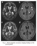 IgG4-Related Disease Complicated by Brain Parenchymal Lesions Successfully Treated with Corticosteroid Therapy: A Case Report