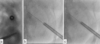 Interventional Radiology