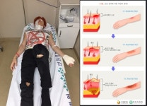 충격 유키스 기섭, 2도 화상, 심재성·표재성 여부 따라 치료기간...  관심 증폭 - KNS뉴스통신 충격 유키스 기섭, 2도 화상, 심재성·표재성... 