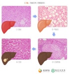 비만 아닌 다낭성난소증후군의 지방간 유병률 연구 [이엠디] 비만 아닌 다낭성난소증후군의 지방간 유병률 연구