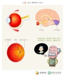 녹내장, 초기 자각 힘들어 주의 필요 한 번 손상된 시신경은 회복 불가 정기적 안과 검진 통한 조기 발견과 치료 중요 녹내장이란 눈과 뇌를... 