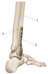 Determining the Tightrope Tightening Force for Effective Fixation of the Tibiofibular Syndesmosis during Osteomeatal Synthesis of... 