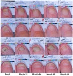 Safety and Efficacy of a 48-Month Efinaconazole 10% Solution Treatment/Maintenance Regimen: 24-Month Daily Use Followed by 24... 