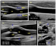 Clinical Significance of Carotid Intima-Media Complex and Carotid Plaque Assessment by Ultrasound for the Prediction of Adverse... 