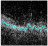Fig. 4-11, Enlargement of image from Fig. 4-10 - Image Processing in Optical Coherence Tomography - NCBI Bookshelf