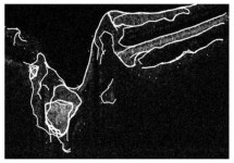 4-79, Action of modified active contour after the described... Δα=1, Δxy=Ne=11, Me=11 - Image Processing in Optical Coherence... 