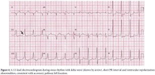 Typical Atrioventricular Nodal Reentrant and Orthodromic Atrioventricular Tachycardias: Electrocardiographic... 