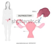 팔로피안 관암 제거수술 스톡 벡터(로열티 프리) 2245461315 | Shutterstock