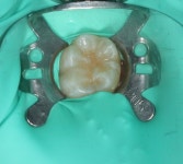 치면열구전색 [Sealant] | 의학정보 | 건강정보 | 서울대학교병원 치면열구전색 | Sealant | 의학정보 | 건강정보 | 서울대학교병원