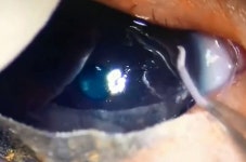 Stomach-churning moment doctors remove 11 live worms from a babys EYE | The Irish Sun Stomach-churning moment doctors remove 11... 