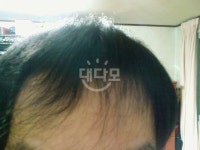 정면입니다 형님분들 삼촌님들 부탁드리겠습니다 정면입니다 형님분들 삼촌님들 부탁드리겠습니다 > 대다모 > 모발이식 FORUM