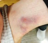 블라인드 | 헬스·다이어트: 바벨25키로에 발목 찍혓는데 헬스·다이어트: 바벨25키로에 발목 찍혓는데