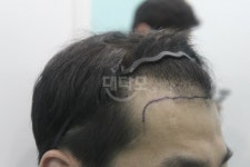 이식 받고 왔는데 어떤지 봐주시면 감사하겠습니다 이식 받고 왔는데 어떤지 봐주시면 감사하겠습니다 > 대다모 > 모발이식포토평가