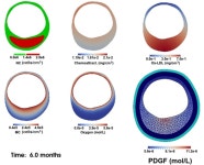 경청원 | Figure 4 from An integrated approach to simulating the vulnerable atherosclerotic plaque. | Semantic Scholar