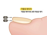 모모뷰티앤발톱전문가내성발톱발톱무좀전문 | 발톱무좀 - 나무위키 발톱무좀