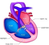 팔로4증: 폐동맥협착, 우심실비대, 심실중격 결손, 대동맥 기승 (증상: 청색증, 무산소발작, 곤봉지, 심잡음)