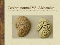 Demencias slideshare