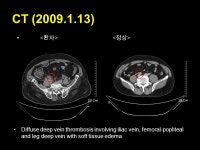 서울노&기내과 | CASE Presentation 2009 년 안산중앙병원 1 기 내과 인턴 박지수. Patient information NAME: 유 O 상 Sex/Age: M/ ppt download