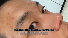 더쿠 - 여드름, 트러블, 수부지, 민감성 피부 유튜버가 추천하는 내돈내산 스킨케어 찐템
