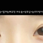 자세한 상담 및 문의⬇️ 📞02)542-8811 💬윙크성형외과의원 | Instagram Instagram의 윙크성형외과 WINK整形外科님 : "어떤 눈이라도...