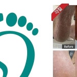 닥터아이티엔페디네일광주 | (단 네일, 미용, 헤어, 피부 등 뷰티 종사자 검증 후)(홈페이지... #내성발톱 #무좀발톱 #발각질 #페디아이티엔 #닥터아이티엔- 4일 뒤인 1월...