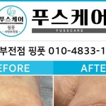푸스케어서면부전점핑풋 | 푸스케어서면부전점 | 서면내성발톱| 문제성발톱 | 서면발톱무좀... 예약 카카오채널 @푸스케 어서면부전점핑풋010-4833-1745"