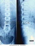 럼보-사천 척추의 엑스레이 럼바 스폰디아병 최소한의 스톡 사진 2404234021 | Shutterstock