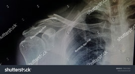 엑스레이 쇼는 클라비클 1/3 중간 샤프트 스톡 사진 1750147262 | Shutterstock